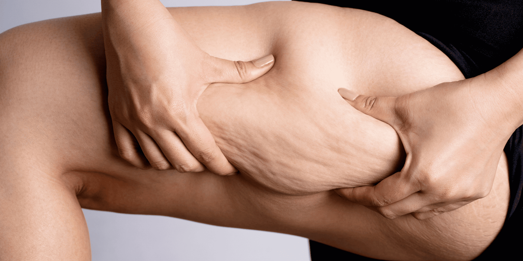 Cellulite